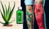 Essential Steps for Effective Burn Treatment Care