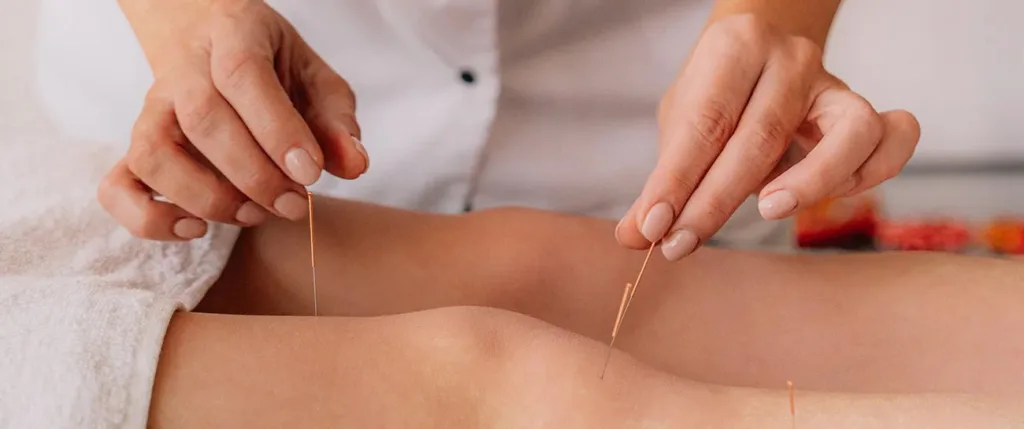 Acupuncture for Stress and Anxiety: A Comprehensive Guide