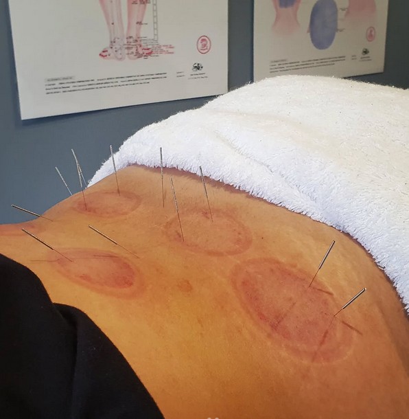 Sports Recovery Acupuncture: 6 Key Benefits You Should Know