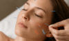 Cosmetic Acupuncture: Important Drawbacks to Keep in Mind